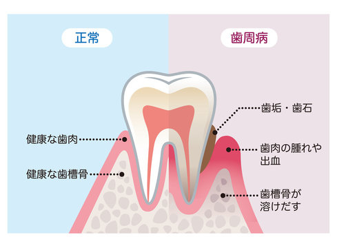 歯周病予防と歯の健康を守る定期メンテナンスのすすめ